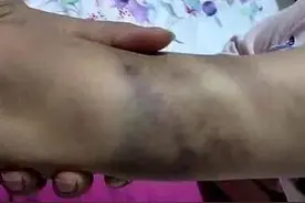 怒了！作业未完成，小学生竟被老师打成这样图片