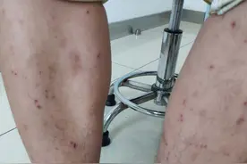 痒哭！宁波25岁姑娘睡醒身上爆出好多小红点！这症状最近高发图片