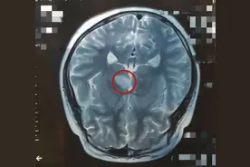 13岁男孩被查出中风！这两个因素竟是最大“元凶”……图片