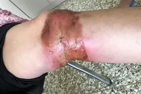 野芹菜能治关节炎？六旬大妈迷信偏方全身深二度烧伤图片