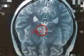 13岁男孩看东西重影，以为手机看多了，医生：中风！出现这些症状要注意图片