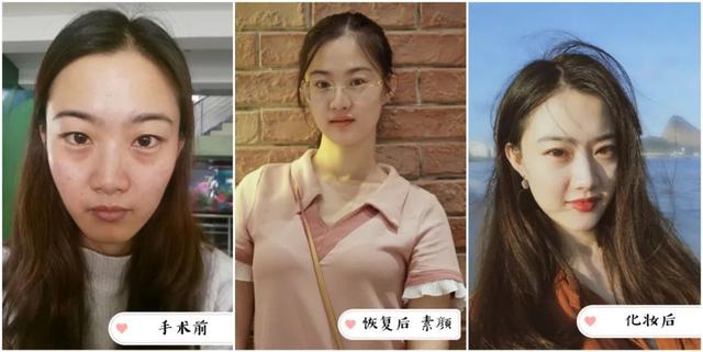 脂溢性角化激光大概费用