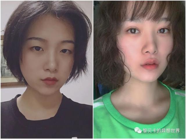 脂溢性角化激光大概费用