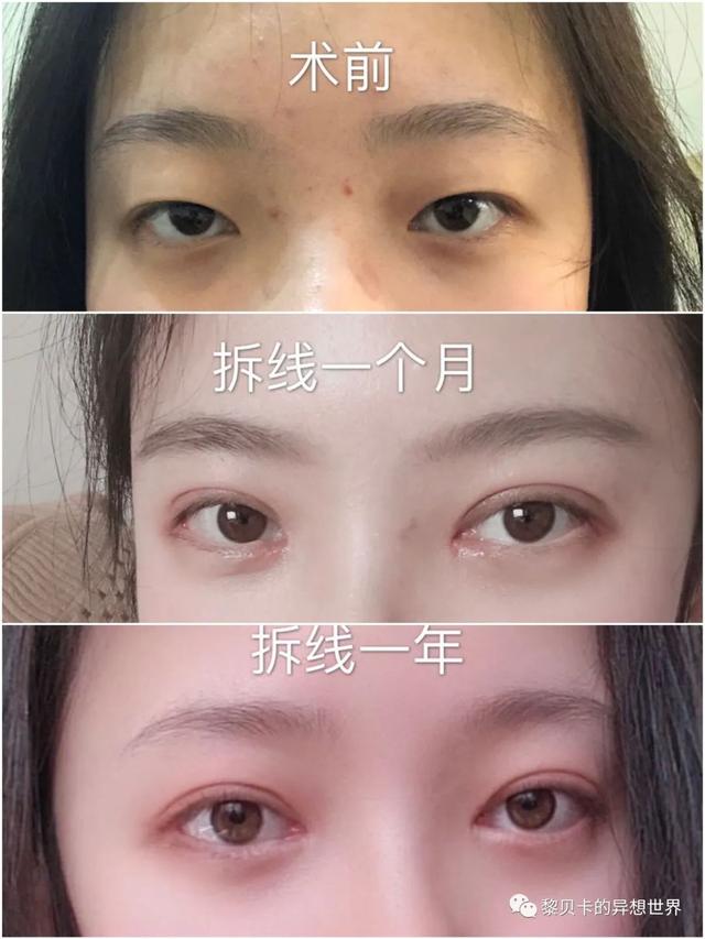 脂溢性角化激光大概费用