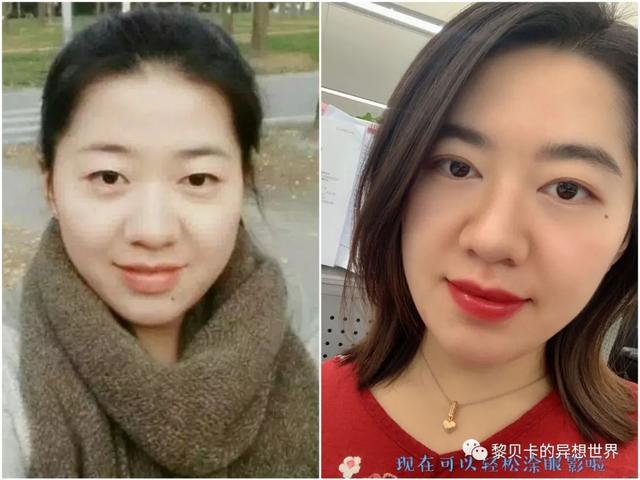 脂溢性角化激光大概费用