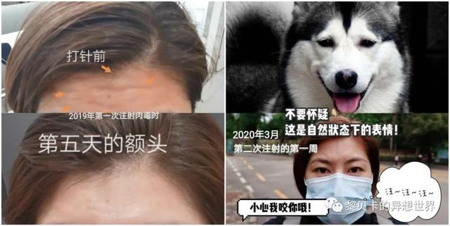 脂溢性角化激光大概费用