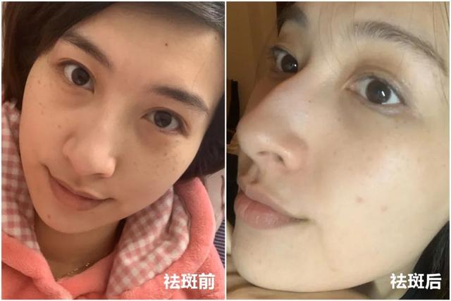 脂溢性角化激光大概费用
