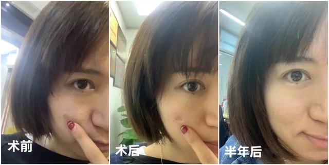 脂溢性角化激光大概费用