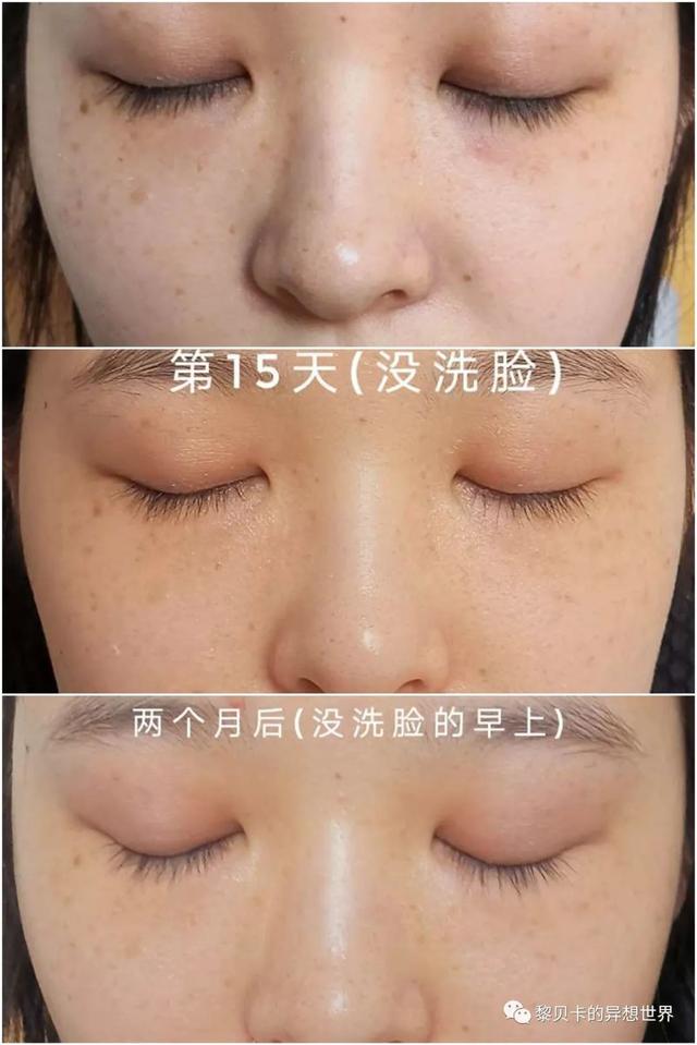 脂溢性角化激光大概费用