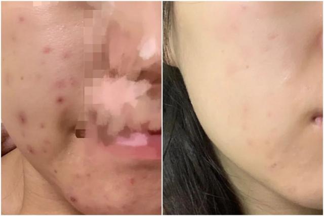 脂溢性角化激光大概费用