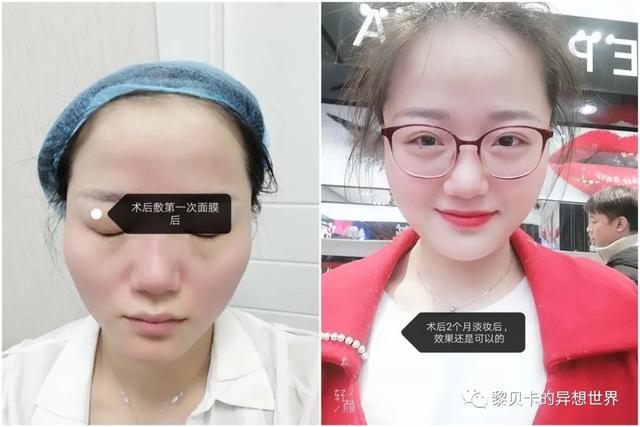 脂溢性角化激光大概费用