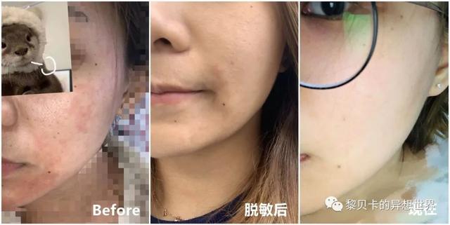 脂溢性角化激光大概费用