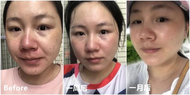 脂溢性角化激光大概费用