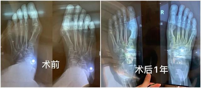 脂溢性角化激光大概费用