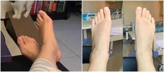 脂溢性角化激光大概费用
