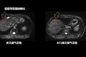 百秒成像！联影全球首款“秒级”磁共振加速技术ACS云端首发图片