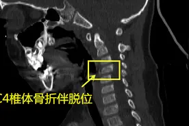 宁波3岁男孩翻跟斗险些瘫痪！提醒：幼童玩耍莫离视线图片