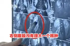 高烧39度腰疼了几个月，排除新冠肺炎，没想到“元凶”竟是它图片