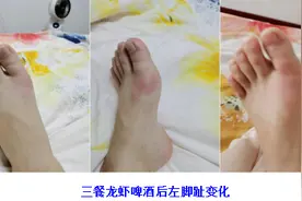 湖南男子连续三天啤酒小龙虾“狂欢”，左脚疼痛难忍，一查竟是“痛风”图片
