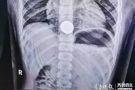 5岁男孩误吞硬币 新泰市中医医院医生巧用软管将硬币取出图片