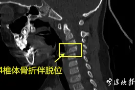 3岁男孩险些下肢瘫痪！医生：小区里都有的这个地方，千万不能这么玩图片