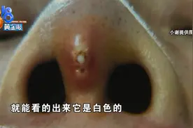 杭州姑娘做完手术三年后，鼻头下面假体露了出来图片