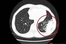大叔肺炎咳血不见好 竟是病死率为五成的罕见真菌感染图片