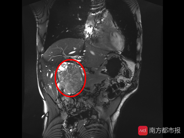 胆囊癌能活多久（胆囊癌注定只有3个月命广州这家医院帮他逆天改命）