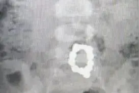 又是因为误吞它！贵州2岁幼儿腹部疼痛达两个月，家长的做法心太大……图片