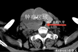婆婆反复梦到被人“掐脖子”，医生揪出原因，竟是这个惹的祸图片
