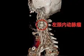 起床身体发麻 检查结果让人捏把汗 耳垂下长了串“要命”的“大葫芦”图片
