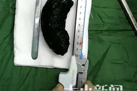 烟台七十岁老人胃穿孔，医生取出10公分结石，只因爱吃这个……图片