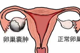 卵巢囊肿是怎么形成的图片