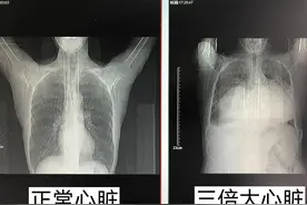 7旬婆婆心脏是常人的3倍大 医生下病危通知书：随时有猝死风险图片