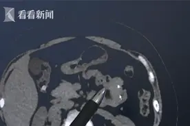 吃火锅后肚子疼了好几天 一查CT小肠里竟有一根完整牙签图片