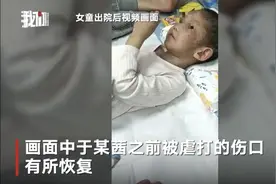 建三江遭“继母”虐打女童出院，目前仍在接受康复治疗图片