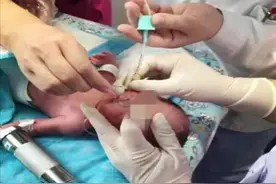 济南一对双胞胎宝宝34周早产重度窒息，30天成功闯过贫血关、感染关等关卡图片