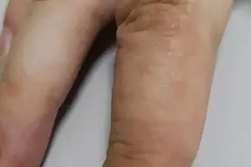千万别挠！最近好多人都长了这种“痒痒的小水泡”！医生提醒，应该这样对付它……图片