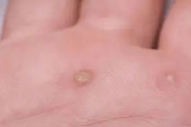 What？手上的瘊子竟然和HPV有关系？图片