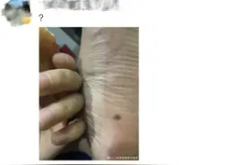 这几天上万网友在身上找痣！长在这些地方的都要切除图片