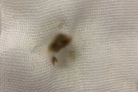 一夜醒来左耳听不见了！医生从她耳朵里挖出一大坨黑色物体……图片