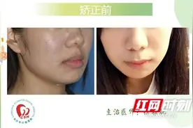 美牙日记—24岁长沙妹子的正畸全过程图片