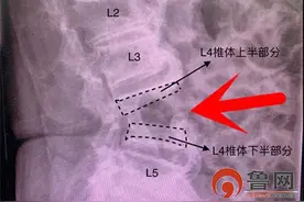 老汉屋顶坠落将腰摔断，看青岛即墨人民医院医生怎么为他“撑腰”图片