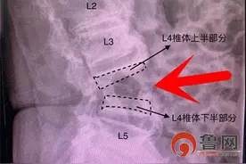 老汉屋顶坠落将腰摔断，看青岛即墨人民医院医生怎么为他“撑腰”图片