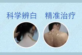 你的孩子也有白癜风吗？关于小儿白癜风最全的笔记图片