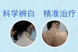 你的孩子也有白癜风吗？关于小儿白癜风最全的笔记图片