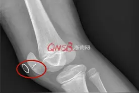 8岁女孩摔倒后右膝盖疼痛难忍，医生竟在里面发现了半根绣花针图片
