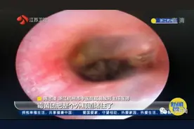 女子突然听不见声音！医生从她左耳里取出蚕豆大的…黄梅天你得注意图片