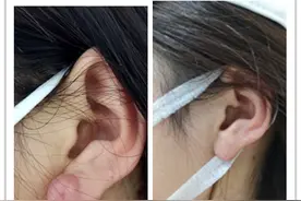 长沙姑娘小耳洞长出大耳垂 医生提醒：穿耳洞要防感染图片