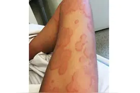 破伤风抗毒素致血清病反应图片